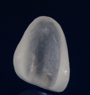 Porcelain veneers